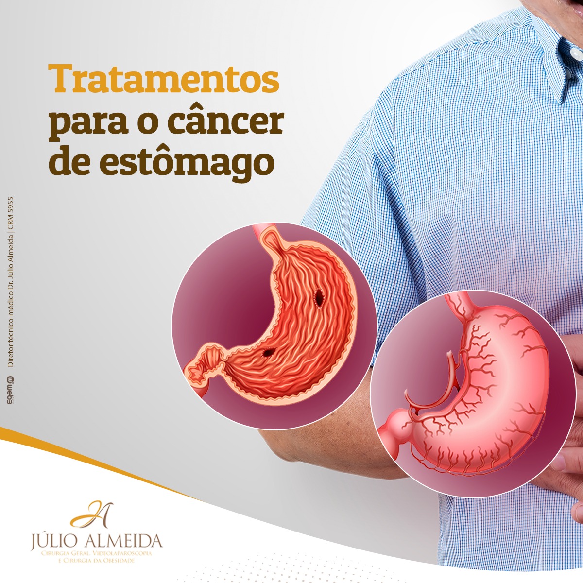 Dr Alexandre - Tratamentos para o câncer de estômago